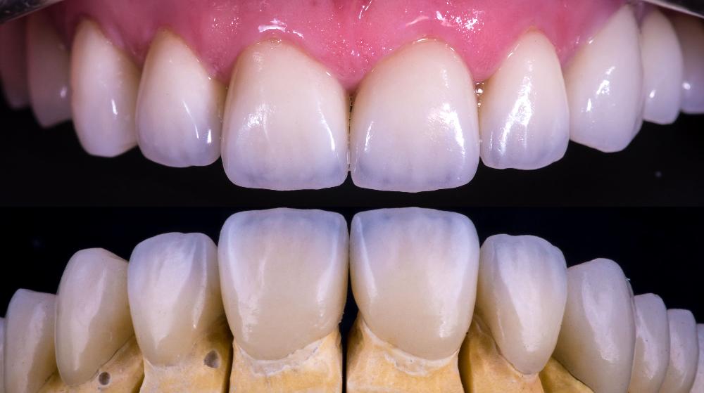 dental veneers | cosmetic dentist east hills, NSW