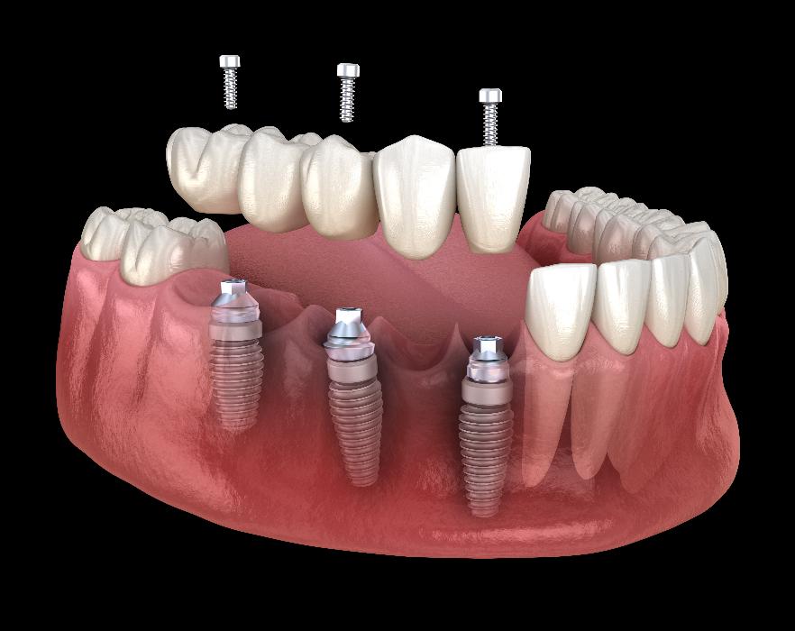 illustration of dental implants east hills, NSW