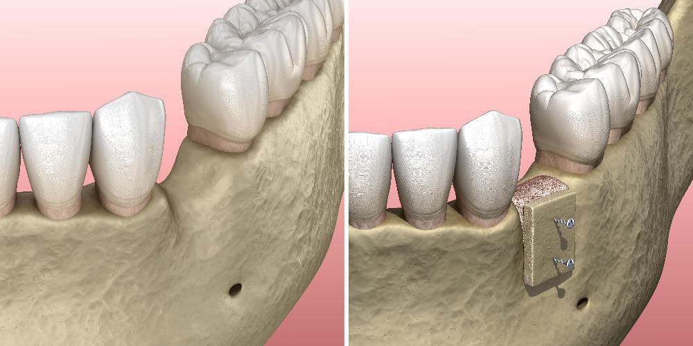 illustration of bone grafting dental surgery East Hills, NSW