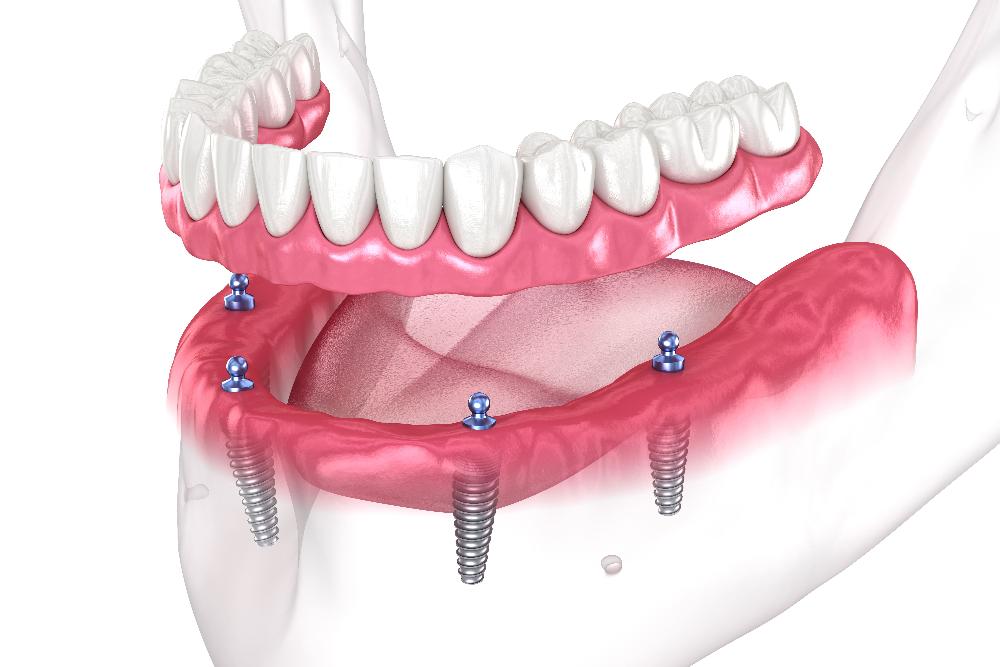 illustration of dentures with dental implants East Hills, NSW 