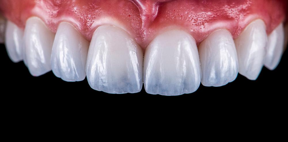 teeth whitening | cosmetic dentist east hills, NSW