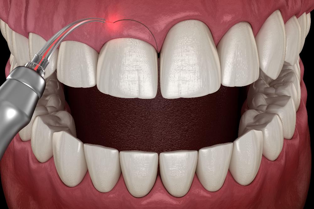 illustration of gum lift dental surgery in East Hills, NSW