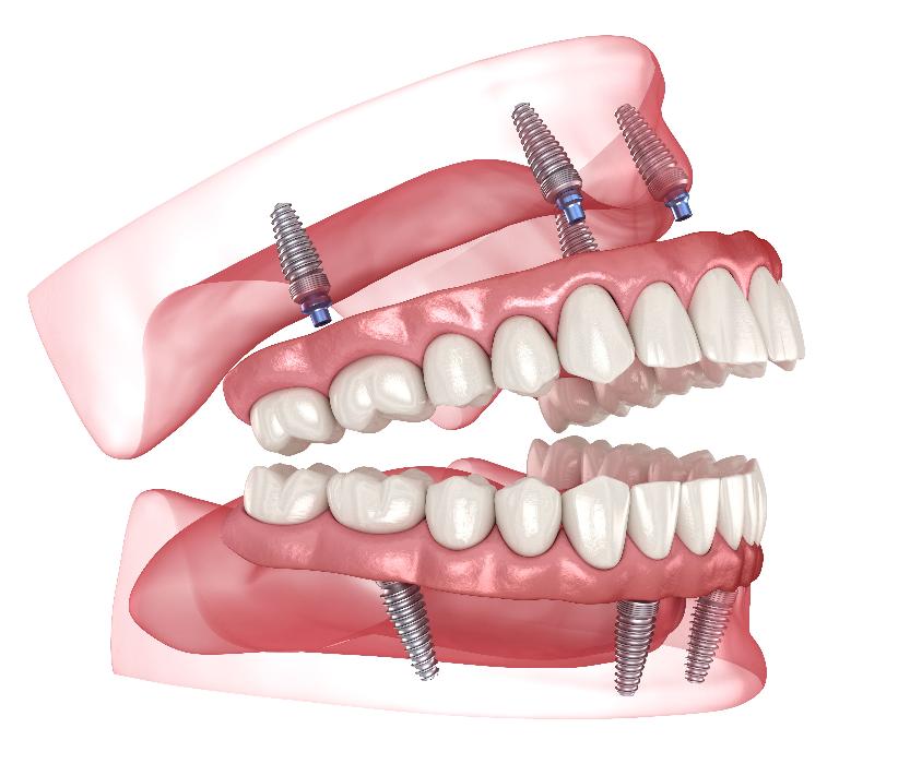 illustration of all on 4 dental implants East Hills, NSW