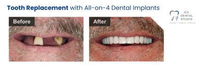 before and after all-on-4 dental implants | dentist east hills
