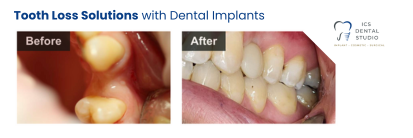 before and after dental implants | dentist east hills