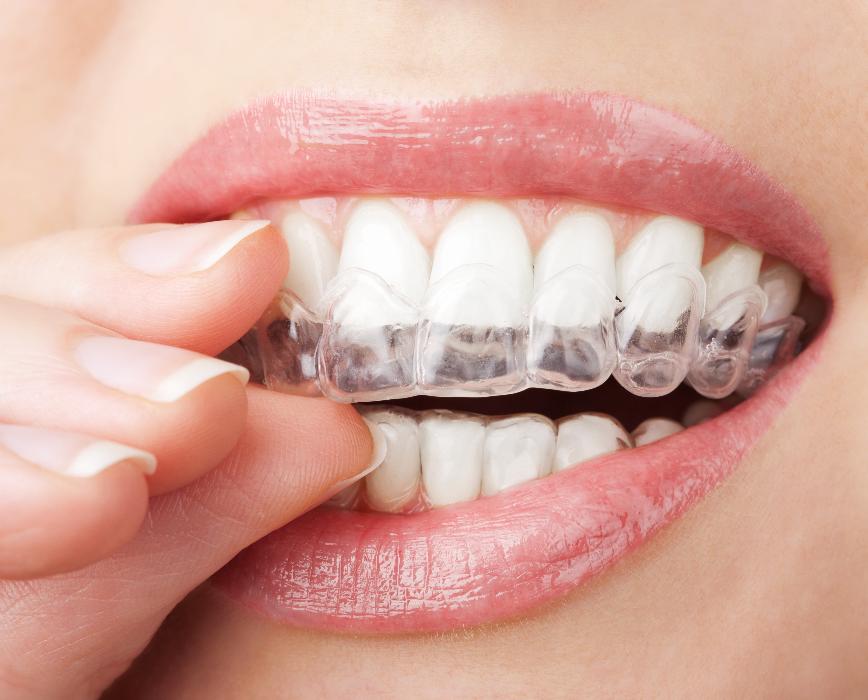 Invisalign east hills, NSW