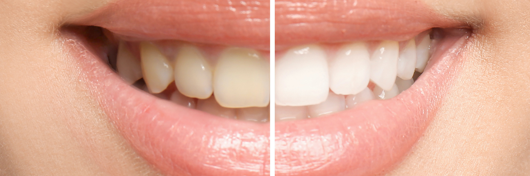 Before and after comparison showing teeth alignment improvement