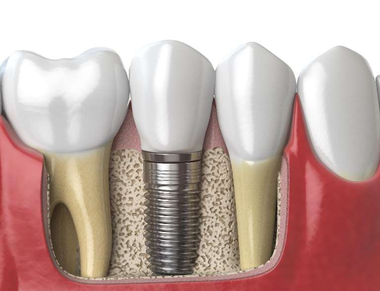 implant dentist east hills | dental implants illustration