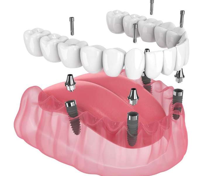 all on 4 dental implants east hills