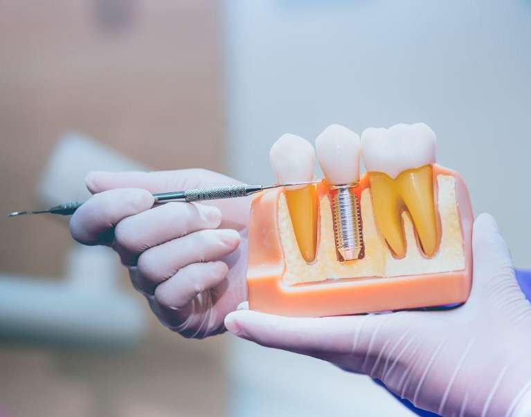 dentist holding dental implant display