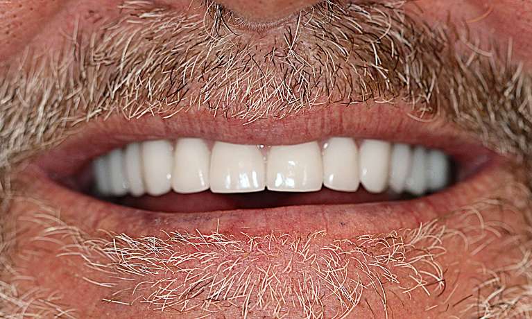 Results-of-All-on-4-Implants-Procedure-After-Image