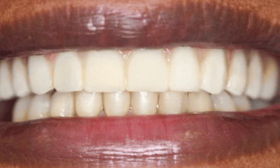 After treatment - All-on-4 Treatment for Upper Teeth