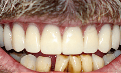After treatment - All-on-4 Treatment for Upper Teeth