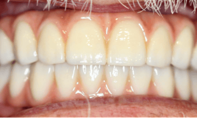 After treatment - All-on-4 Treatment