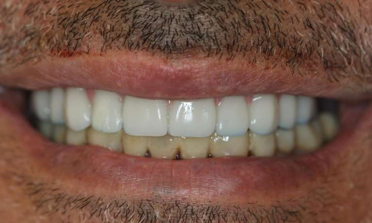 All-on-4-Implants-After-Image