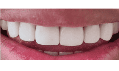 front teeth without teeth after veneers