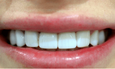 After treatment - Composite Bonding and Veneers