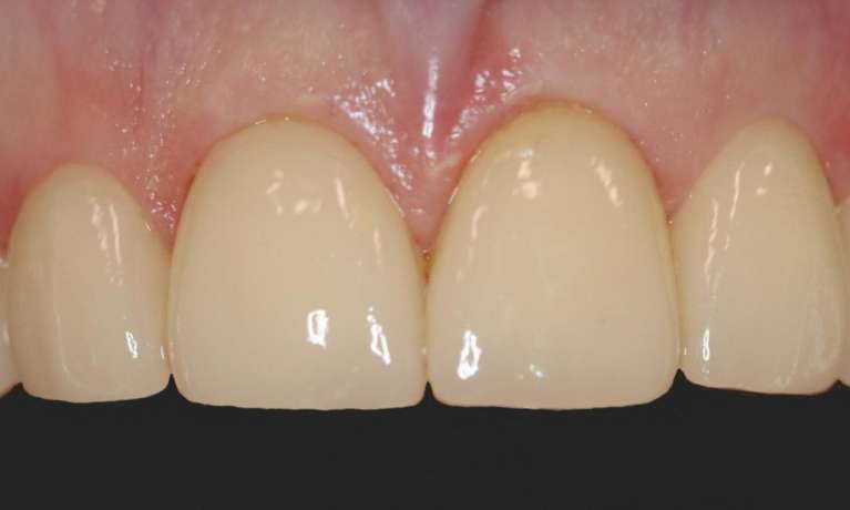 Composite-Bonding-After-Image