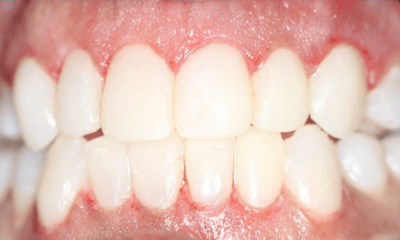 After treatment - Composite Veneers