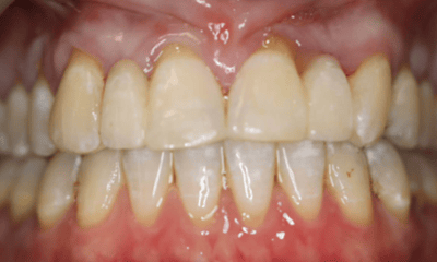 After treatment - Dental Bridge