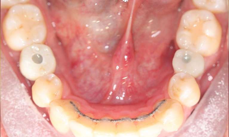 Results-with-Dental-Implants-After-Image