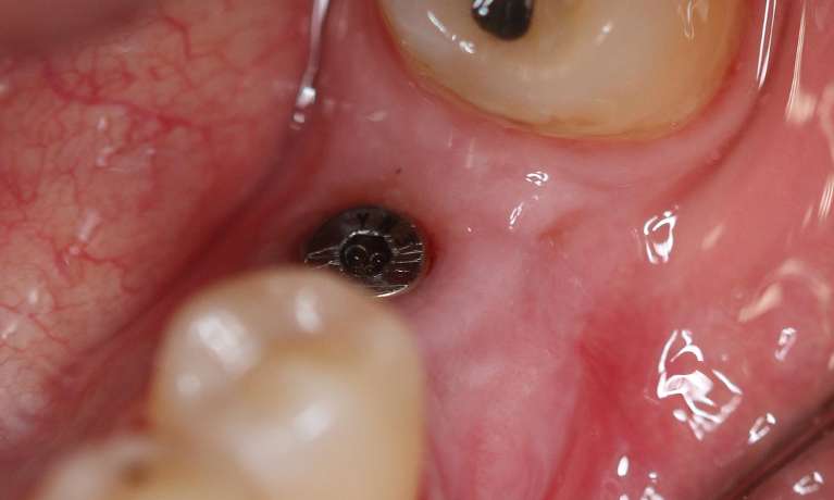Gum-Graft-around-Implant-After-Image