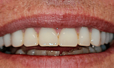 After treatment - Implant-Retained Denture
