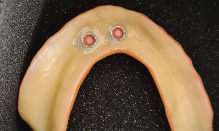 implant-retained dentures east hills