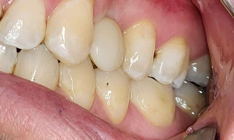 dental implants east hills | after