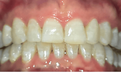 After treatment - Invisalign Treatment