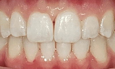 After treatment - Invisalign Treatment