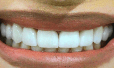 After treatment - Invisalign Treatment