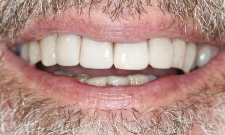 composite bonding after | cosmetic dentist east hills