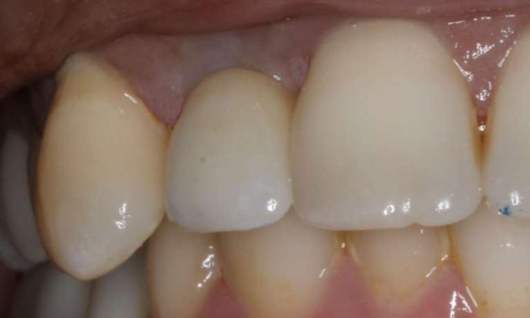 Tooth-Trauma-Fixed-With-Dental-Implant-After-Image