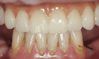 results after all on 4 on upper arch in East Hills