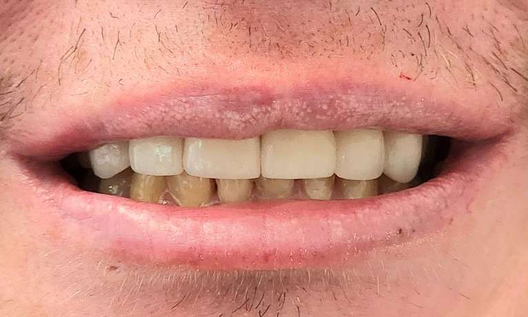 dental veneers east hills | after veneers