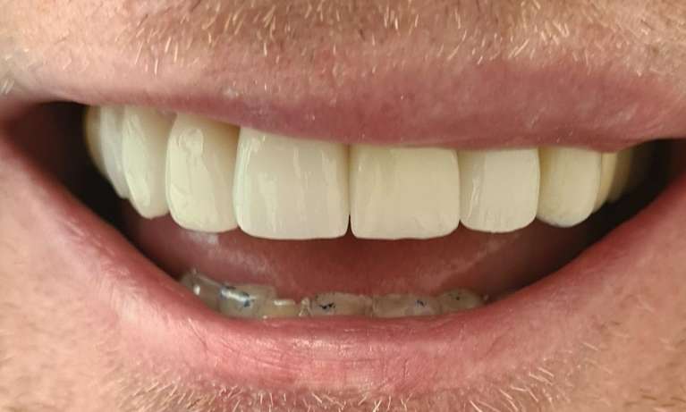 dental veneers east hills | after