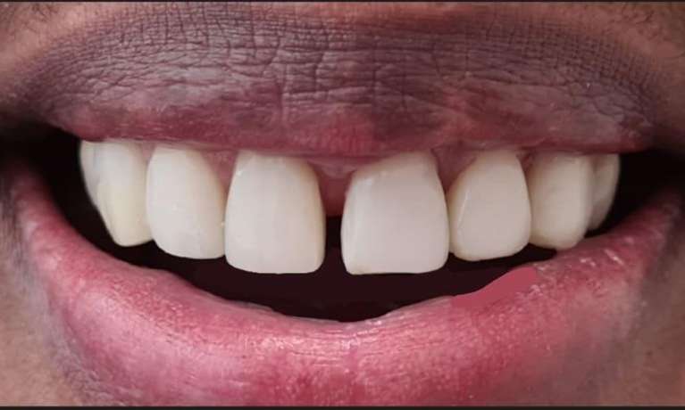 dental veneers east hills | after
