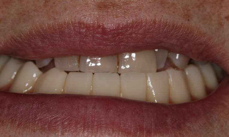 implant-retained dentures east hills | after dentures