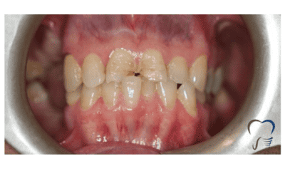 uneven teeth before veneers