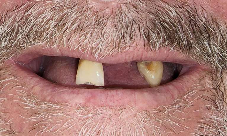 Results-of-All-on-4-Implants-Procedure-Before-Image