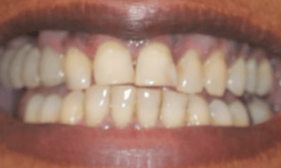 Before treatment - All-on-4 Treatment for Upper Teeth
