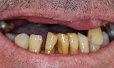 Before treatment - All-on-4 Treatment for Upper Teeth
