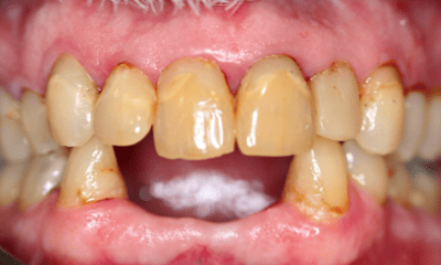 Before treatment - All-on-4 Treatment