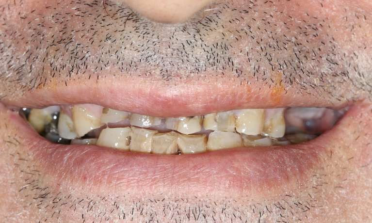 All-on-4-Implants-Before-Image