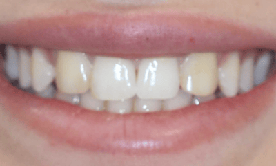 Before treatment - Composite Bonding and Veneers