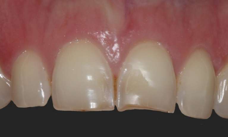 Composite-Bonding-Before-Image