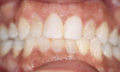 Before treatment - Composite Veneers