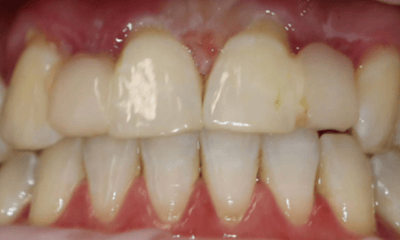 Before treatment - Dental Bridge