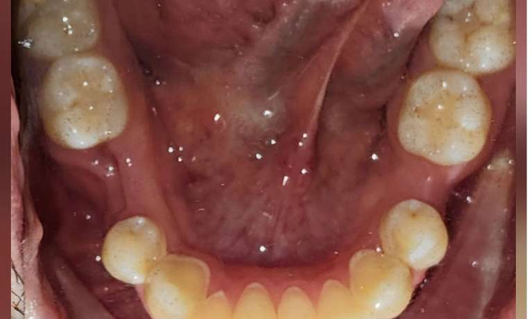 Results-with-Dental-Implants-Before-Image